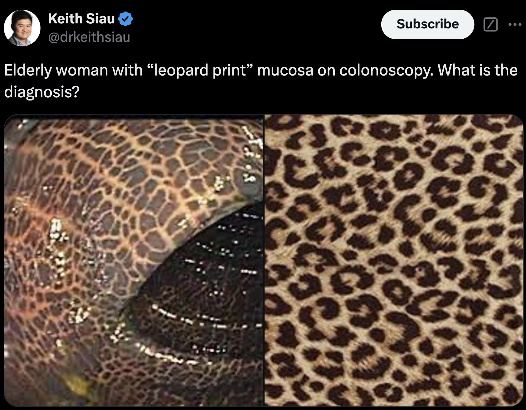 cheetah print wallpaper laptop - Keith Siau Subscribe Elderly woman with "leopard print" mucosa on colonoscopy. What is the diagnosis?